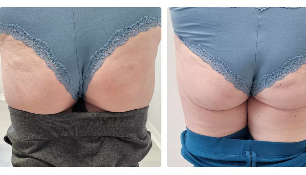 Lift Your Curves with One or Two EMS Butt Lift