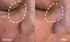 Spider Vein Laser Treatments for Nose, Face & Small Areas at SkinVital Studio (Up to 76% Off)