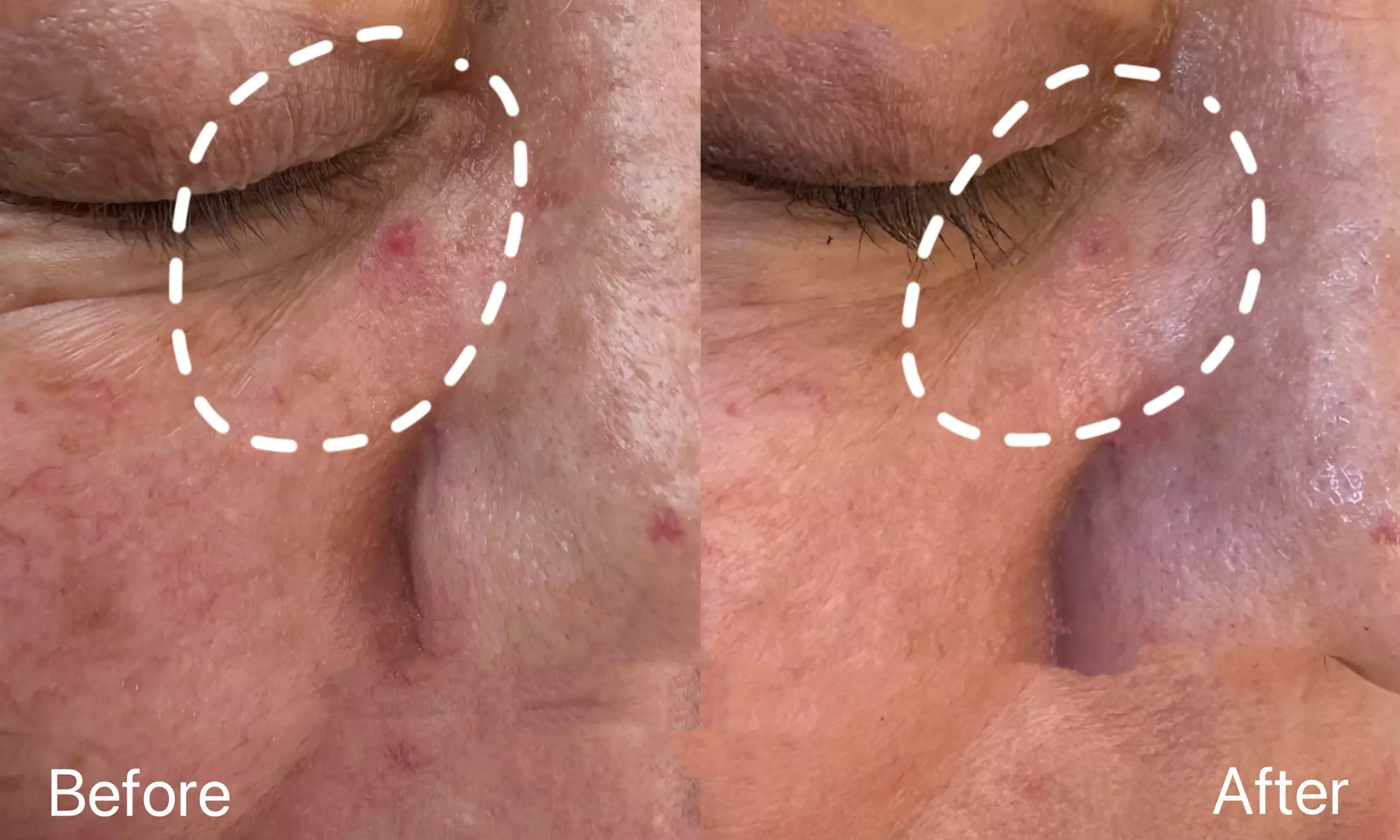 Spider Vein Laser Treatments for Nose, Face & Small Areas
