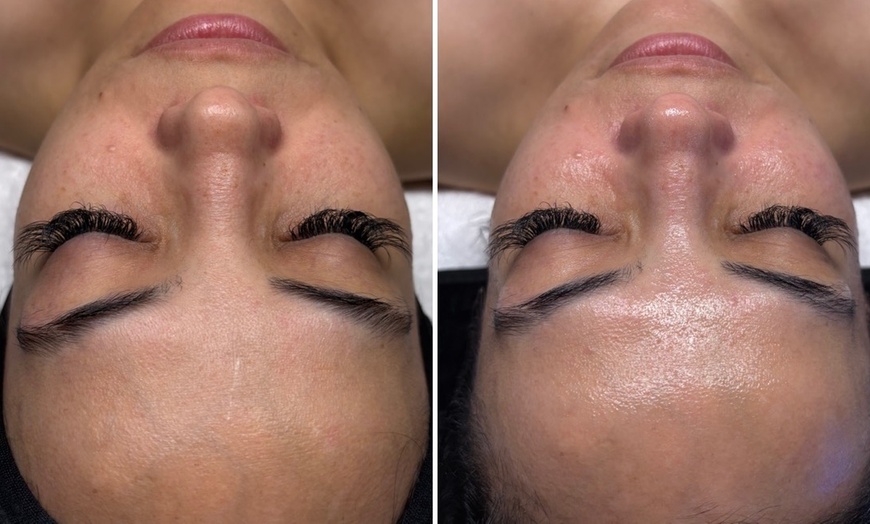 Image 3: One, Two, or Three 30-Minute Signature Hydrafacial Session for One