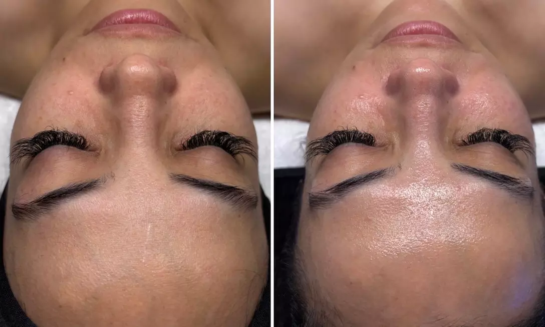 One, Two, or Three 30-Minute Signature Hydrafacial Session for One
