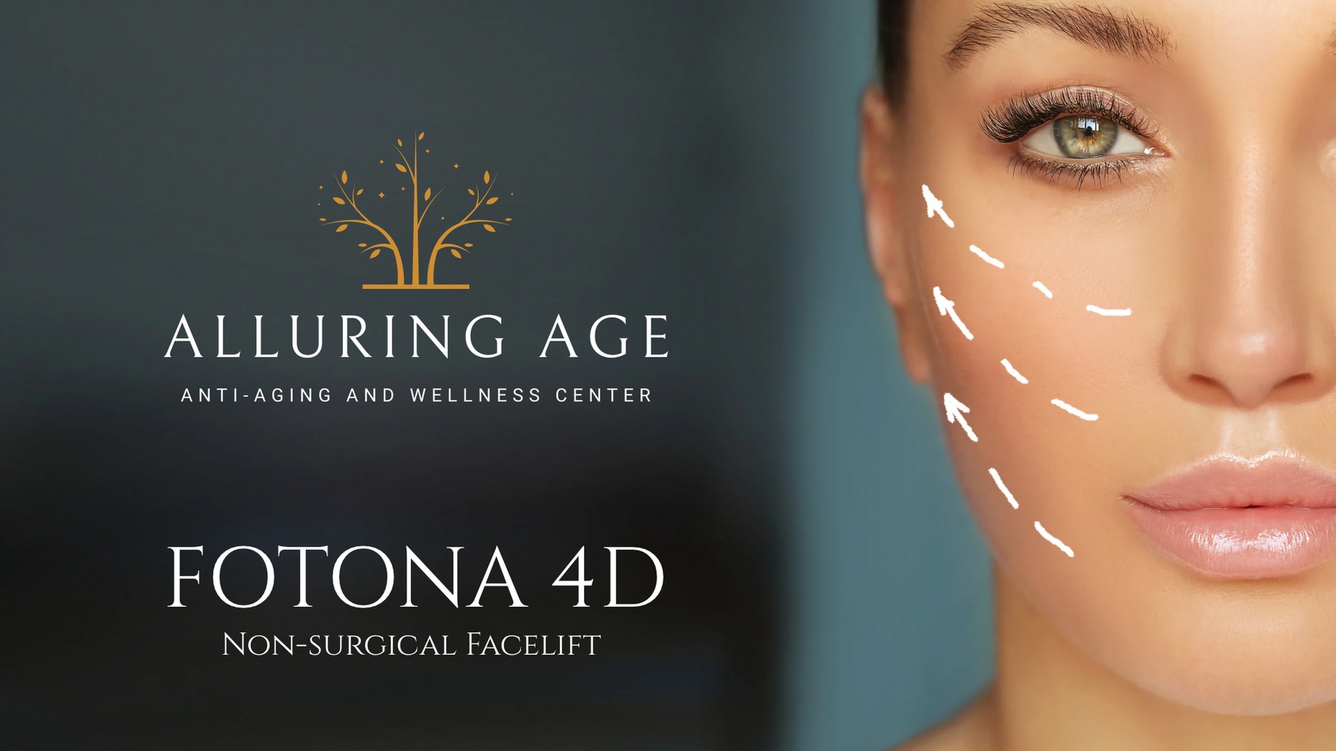 One, Two or Four Fotona 4D Non Surgical Facelifts