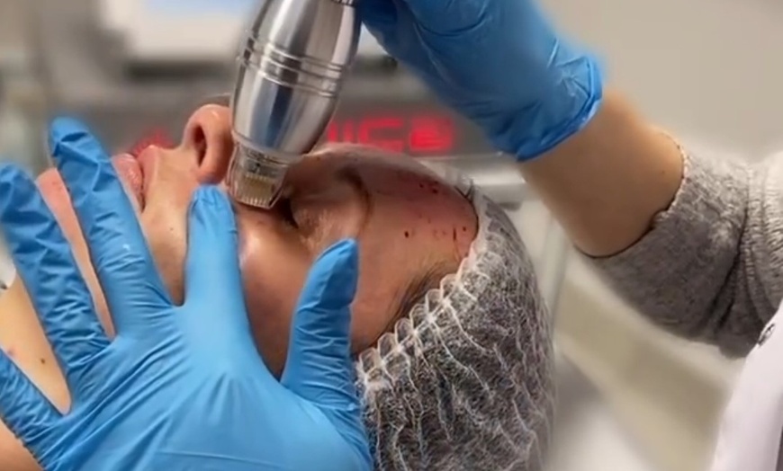 Image 2: Odmładzający zabieg RF mikroigłowy na twarz i ciało dla gładkiej skóry