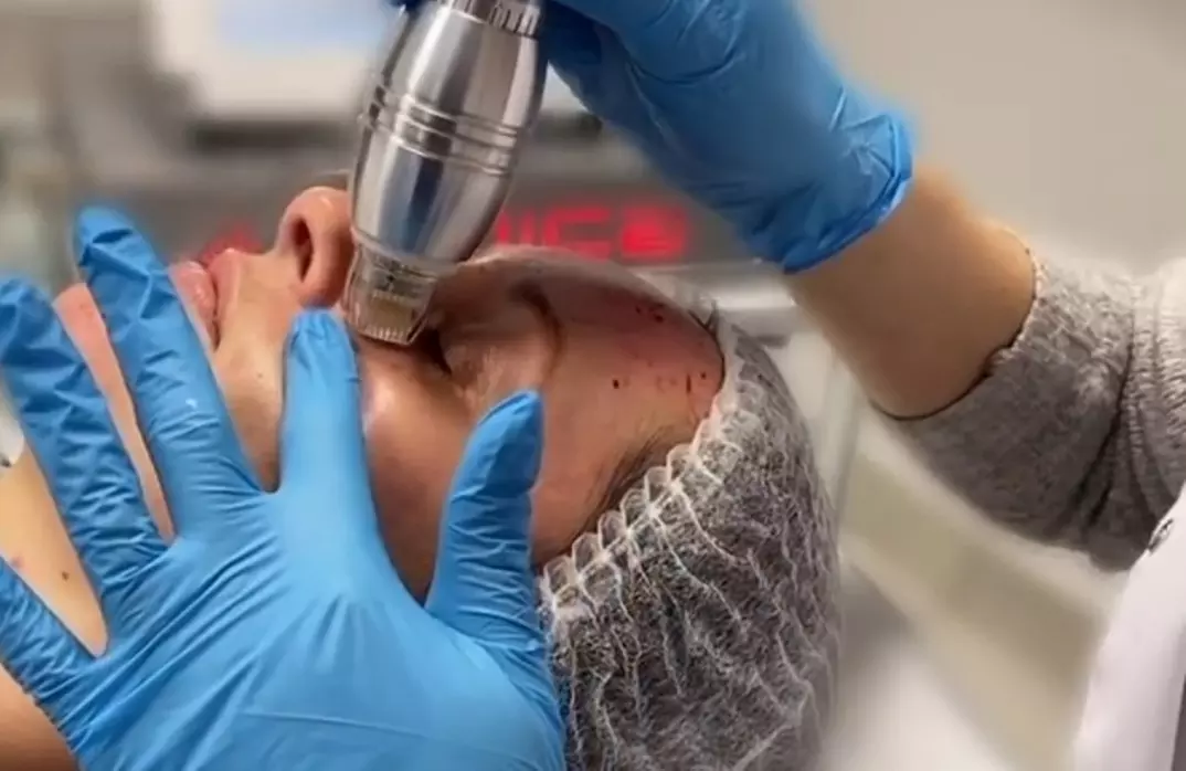 Odmładzający zabieg RF mikroigłowy na twarz i ciało dla gładkiej skóry