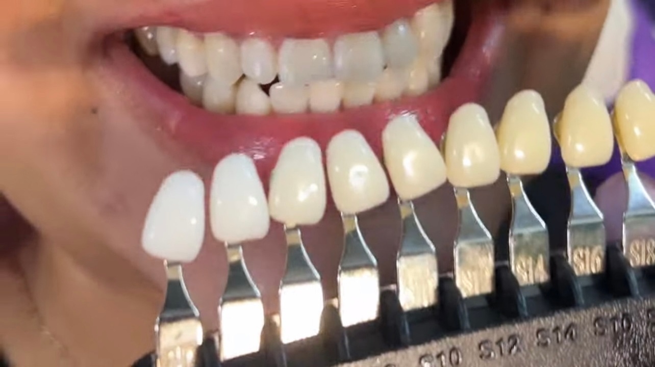 Up to 15% Off on Teeth Whitening - In-Office - Non-Branded 