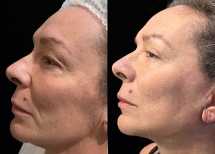 Dual Session: Face & Neck Skin-Tightening Treatment - Ingrid Miller Medical Spa Weston