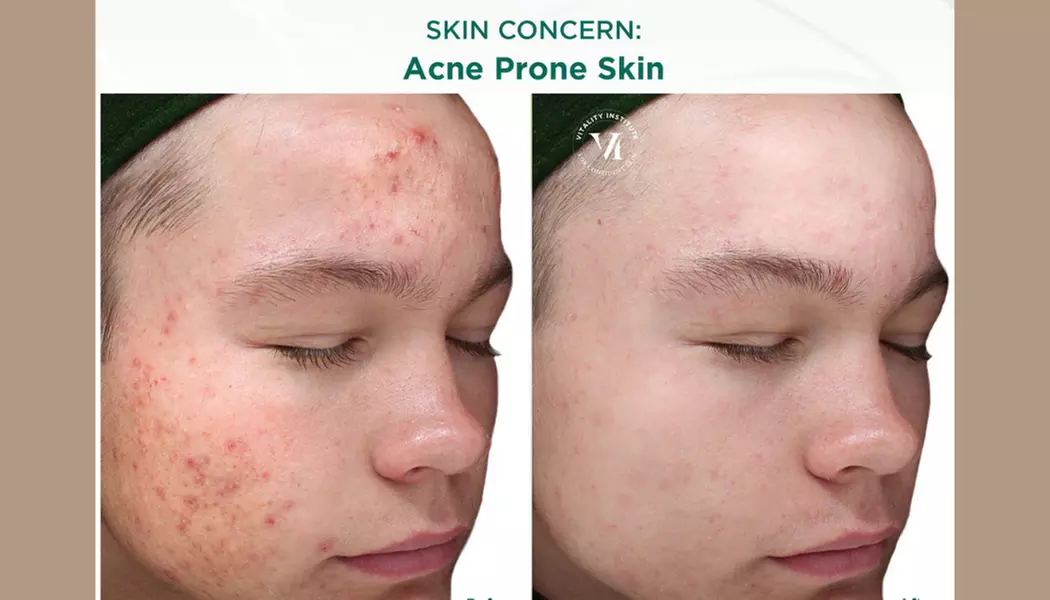 Achieve Clearer Skin with VI Peel Purify