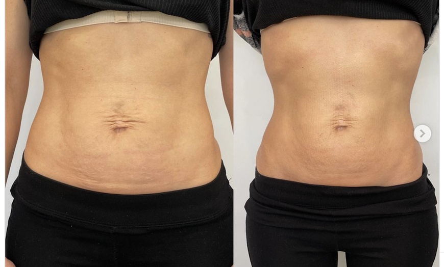 Image 2: Explore HIFU Treatments for Face, Neck, and Body
