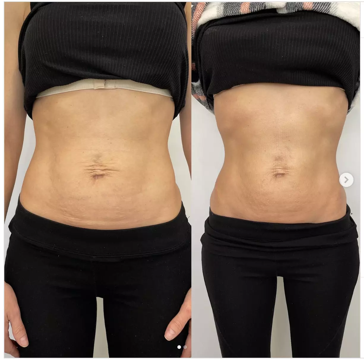 Explore HIFU Treatments for Face, Neck, and Body