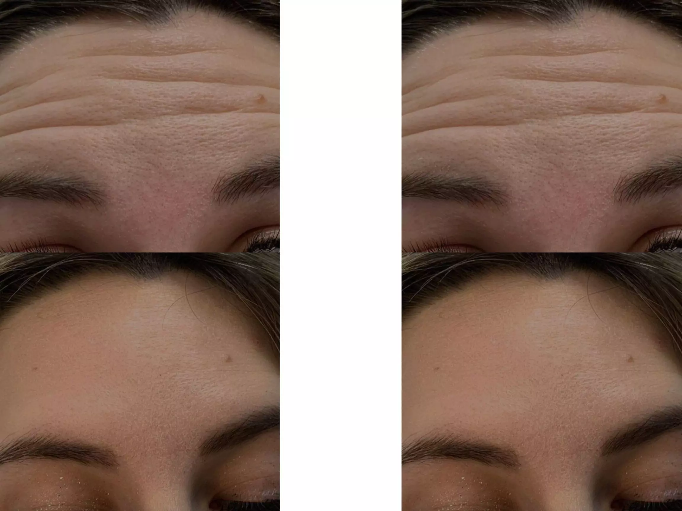 Refresh Your Look with Expert Dysport Injections