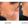 Image 1: Up to 37% Off on Facelift - Non-Surgical at MyBliss Wellness