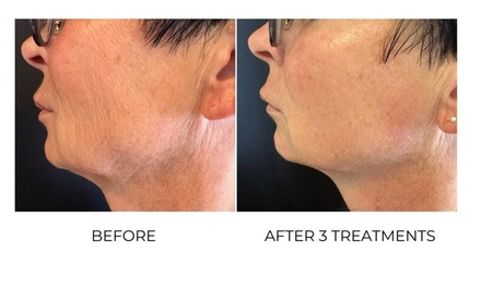 One TSHAPE2 face and neck treatment - MyBliss Wellness