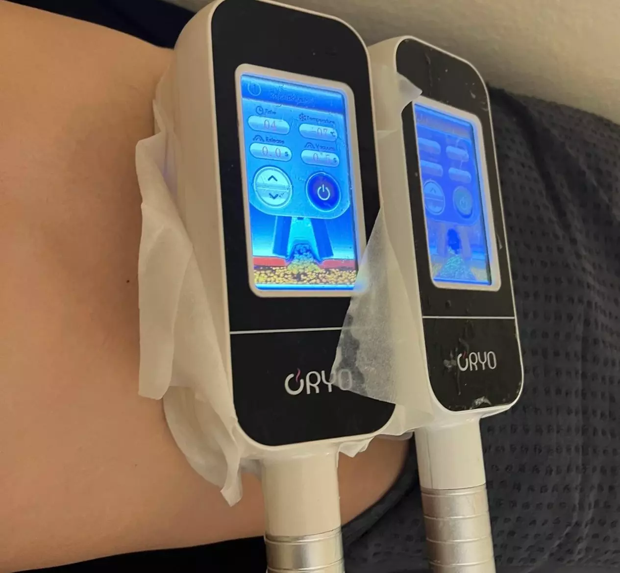 Up to 82% Off on Fat Reduction - Non-Branded at L.A. Fat Freeze