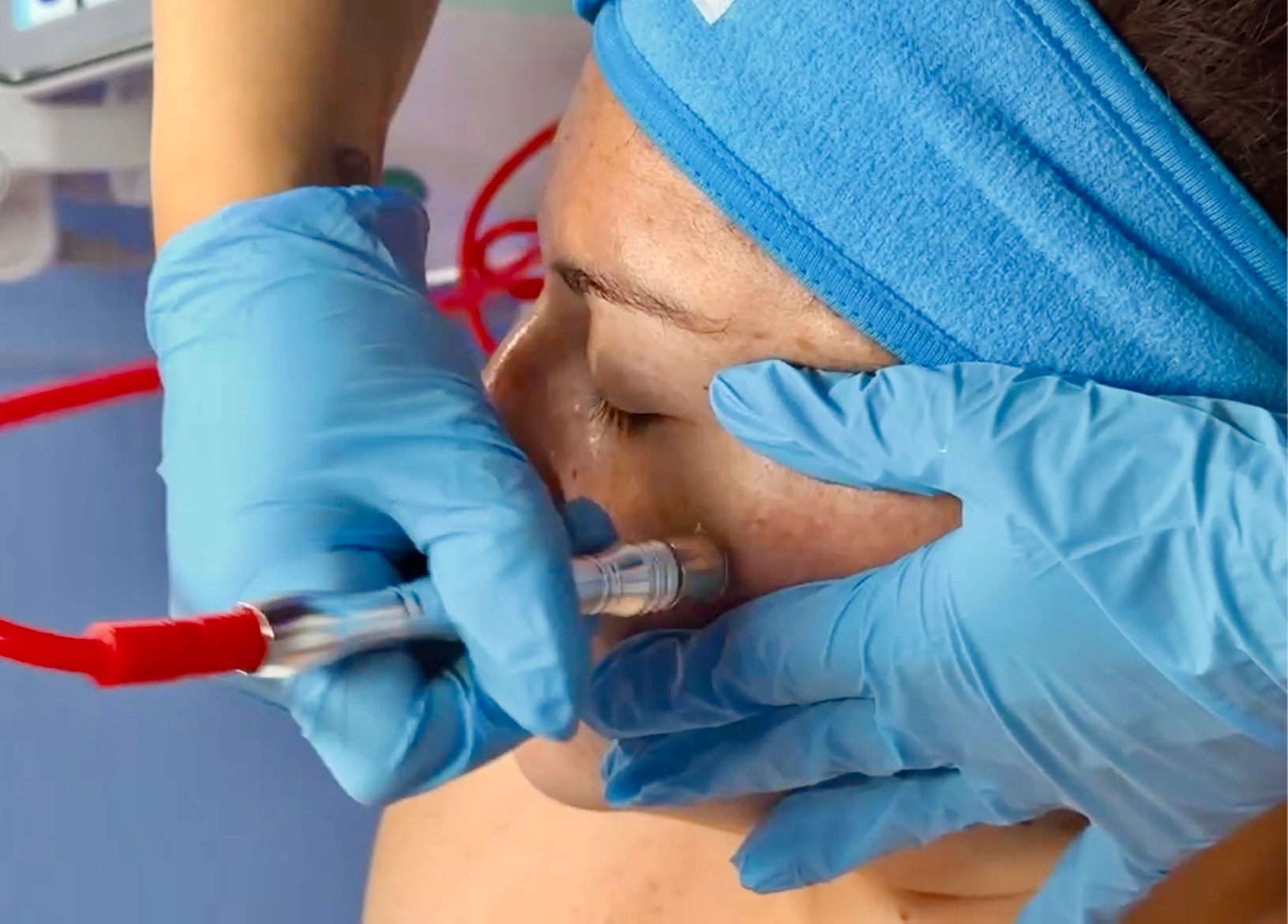Up to 47% Off on Microdermabrasion at RafiXEsthetics - Primary Image