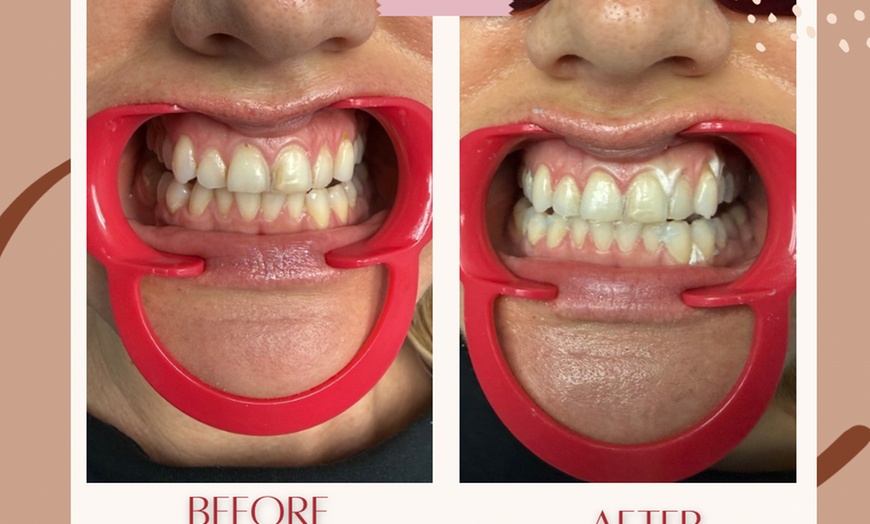 Image 4: Up to 76% Off on Teeth Whitening at Aesthetics Care Med Spa