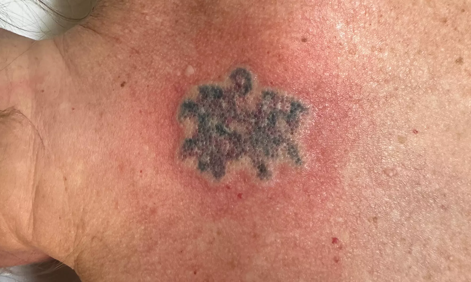 9-Session Laser Tattoo Removal for Areas Less than 1 in up to 88 Sq In
