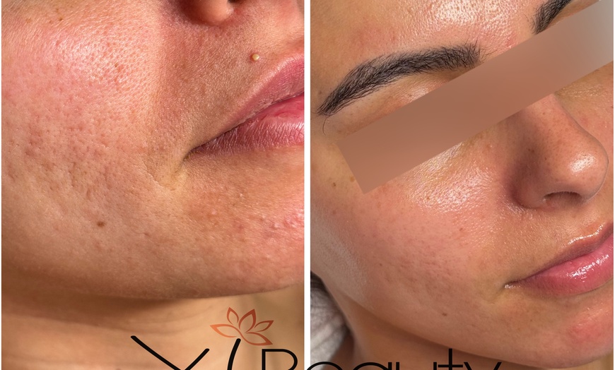Image 2: Up to 35% Off on Facial at Xi Beauty