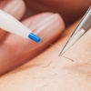 Image 1: Up to 30% Off on Electrolysis at Lasting Lines