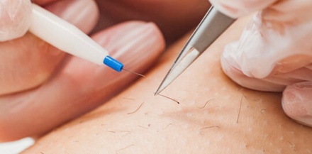 One 60 minute electrolysis session: CALL OR TEXT NUMBER BELOW BEFORE BOOKING - Lasting Lines