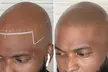 Scalp Micropigmentation Hair-Loss Treatment - Crown, Front, or Filler (Density Effect) - Women/Men(Up to 44%Off) - Second Medium