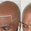 Image 5: Scalp Micropigmentation Hair-Loss Treatment - Crown, Front, or Filler