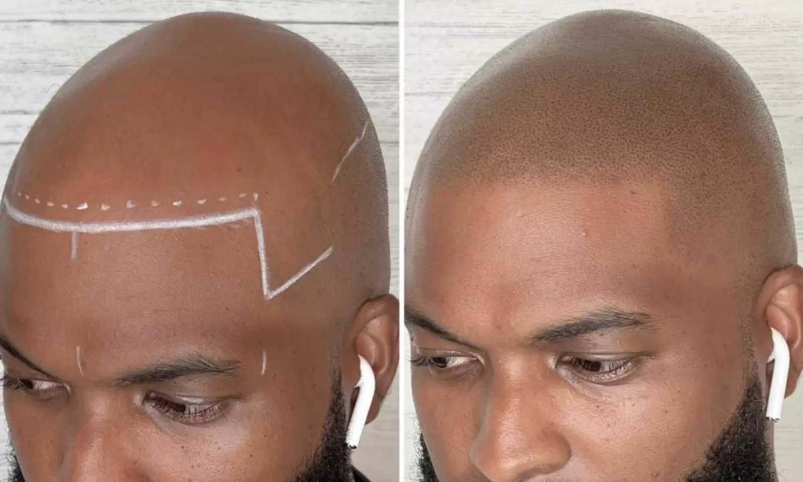 Scalp Micropigmentation Hair-Loss Treatment - Crown, Front, or Filler