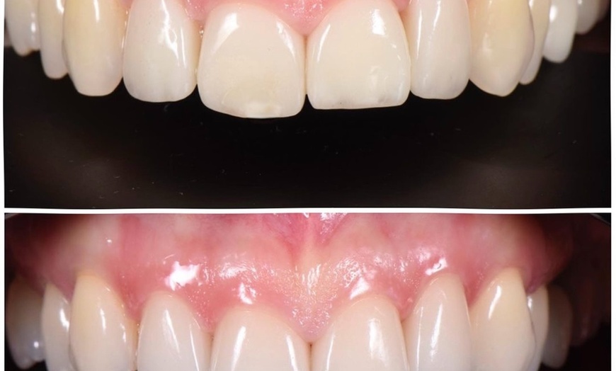 Image 2: Dental Crowns, Dental Exam, X-rays & Cleaning, Dentures & More