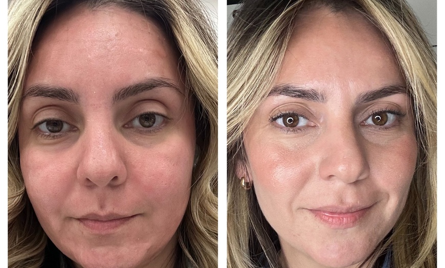 Image 1: Transform Your Skin with One or Three CO2 Skin-Resurfacing Sessions