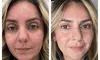Transform Your Skin with One or Three CO2 Skin-Resurfacing Sessions at Amora Med Spa (Up to 77% Off)