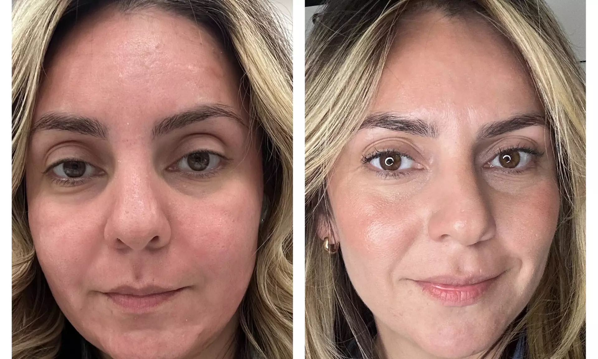 Transform Your Skin with One or Three CO2 Skin-Resurfacing Sessions at Amora Med Spa (Up to 77% Off) - Primary Image