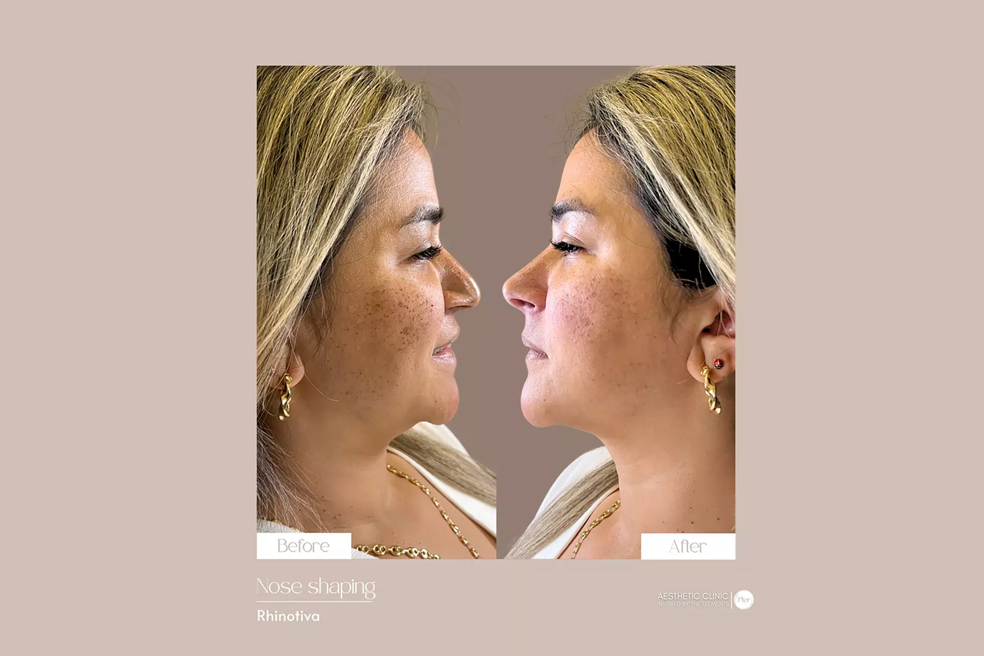 Smooth, Youthful Skin Awaits: 20 or 40 Units of Botox at Pler Miami