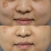 Image 5: Up to 75% Off on IPL/Photofacials at SlimmThicc Aesthetics Spa