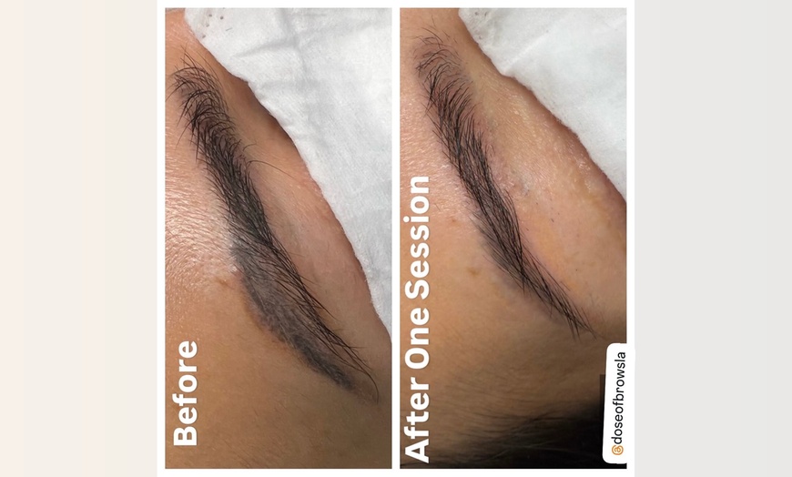 Image 2: Non-Invasive Eyebrow Magnetic Tattoo Removal