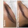 Image 2: Non-Invasive Eyebrow Magnetic Tattoo Removal