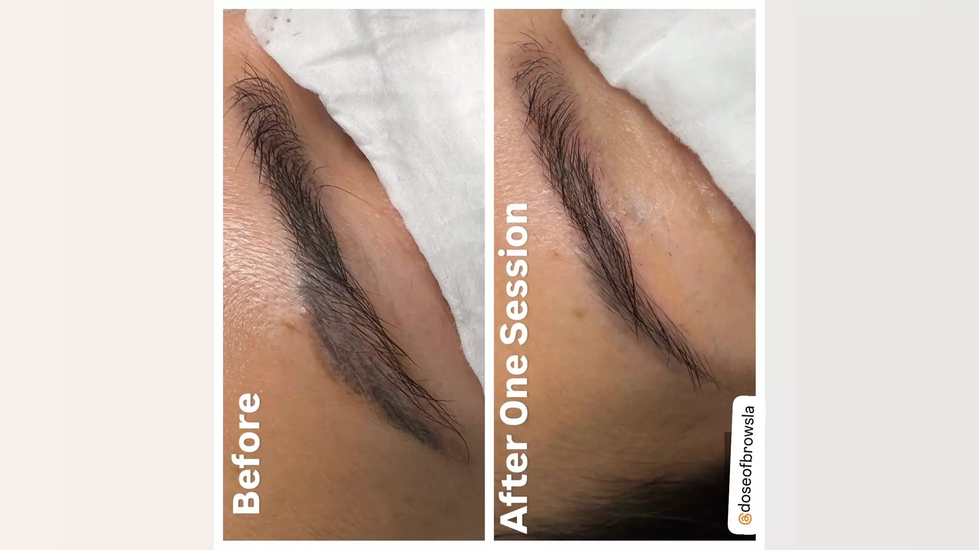 Non-Invasive Eyebrow Magnetic Tattoo Removal