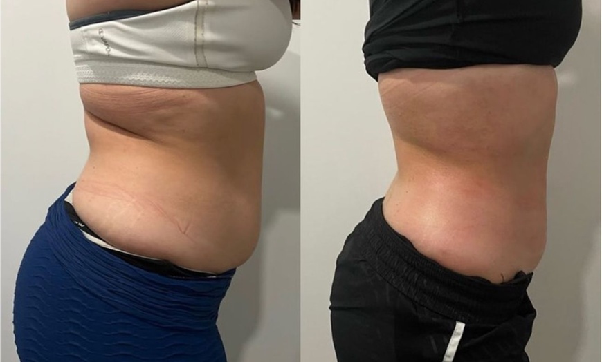 Image 2: Up to 57% Off on Ultrasonic Fat Reduction at ILLUME Skin Spa