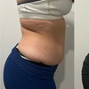 Image 2: Up to 61% Off on Ultrasonic Fat Reduction at ILLUME Skin Spa