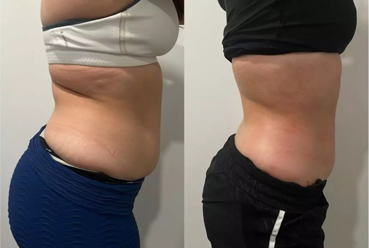 Up to 57% Off on Ultrasonic Fat Reduction at ILLUME Skin Spa