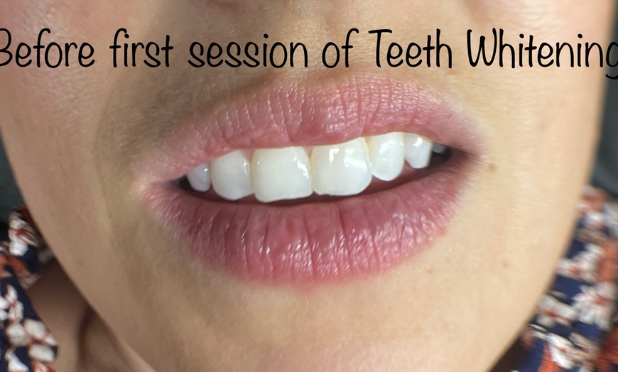 Image 2: Up to 50% Off on Teeth Whitening at Evolve Beauty Bar