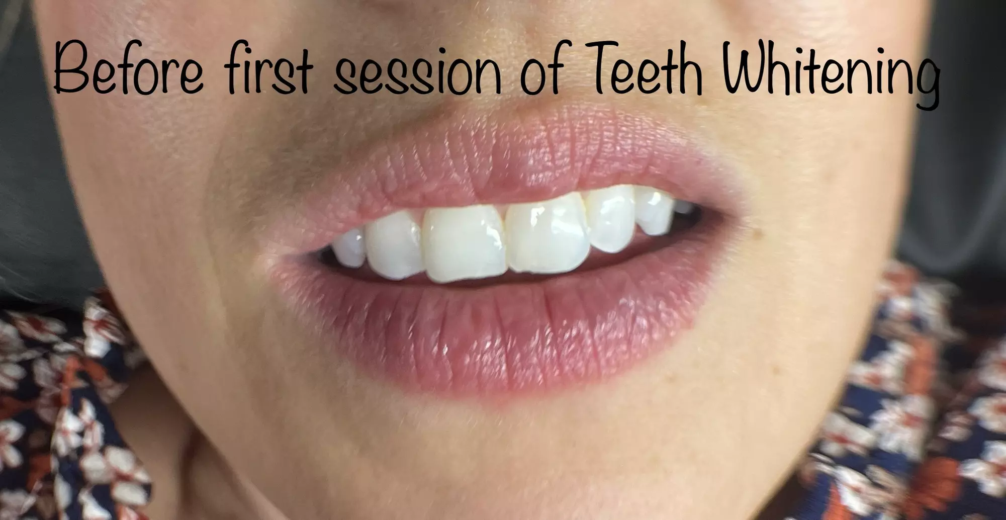 Up to 48% Off on Teeth Whitening at Evolve Beauty Bar