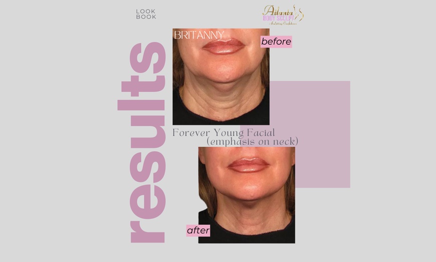 Image 1: Therma-Lift Facelifts for Youthful Skin with No Downtime