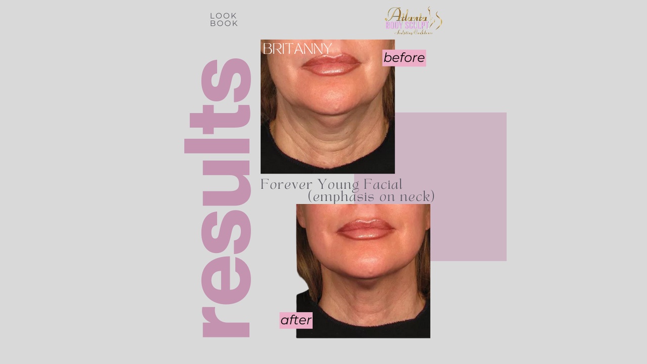 Therma-Lift Facelifts for Youthful Skin with No Downtime