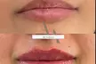 Enhance Your Look with Lip, Cheek or Chin Filler or a Russian Lip Flip Treatment (Up to 50% Off) - Second Medium