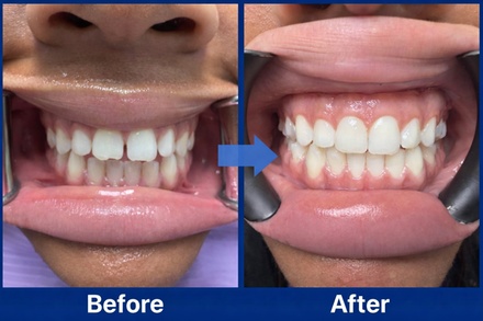Dental exam, X ray, cleaning for One Person - Lumina Dental studio