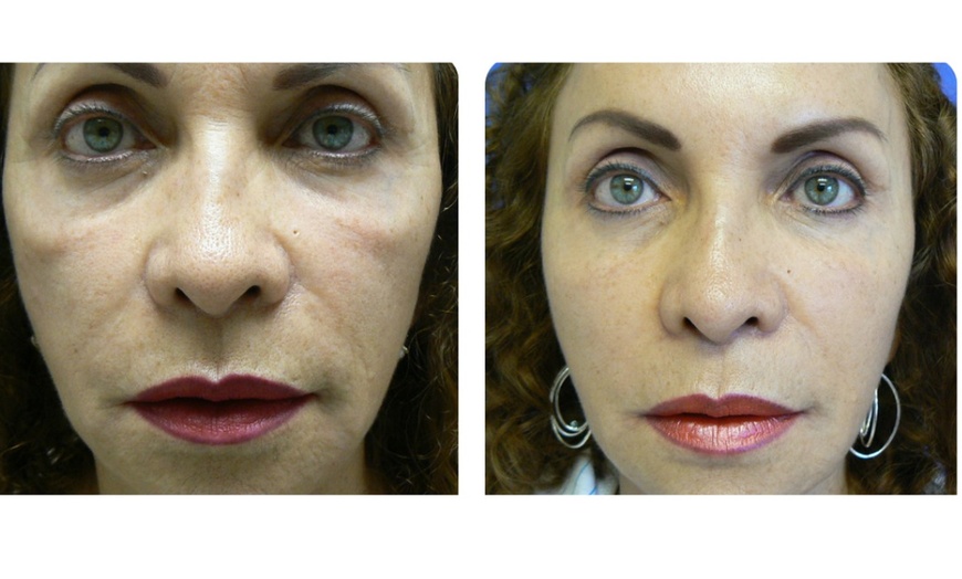 Image 2: One Belotero syringe for undereyes