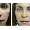 Image 2: One Belotero syringe for undereyes