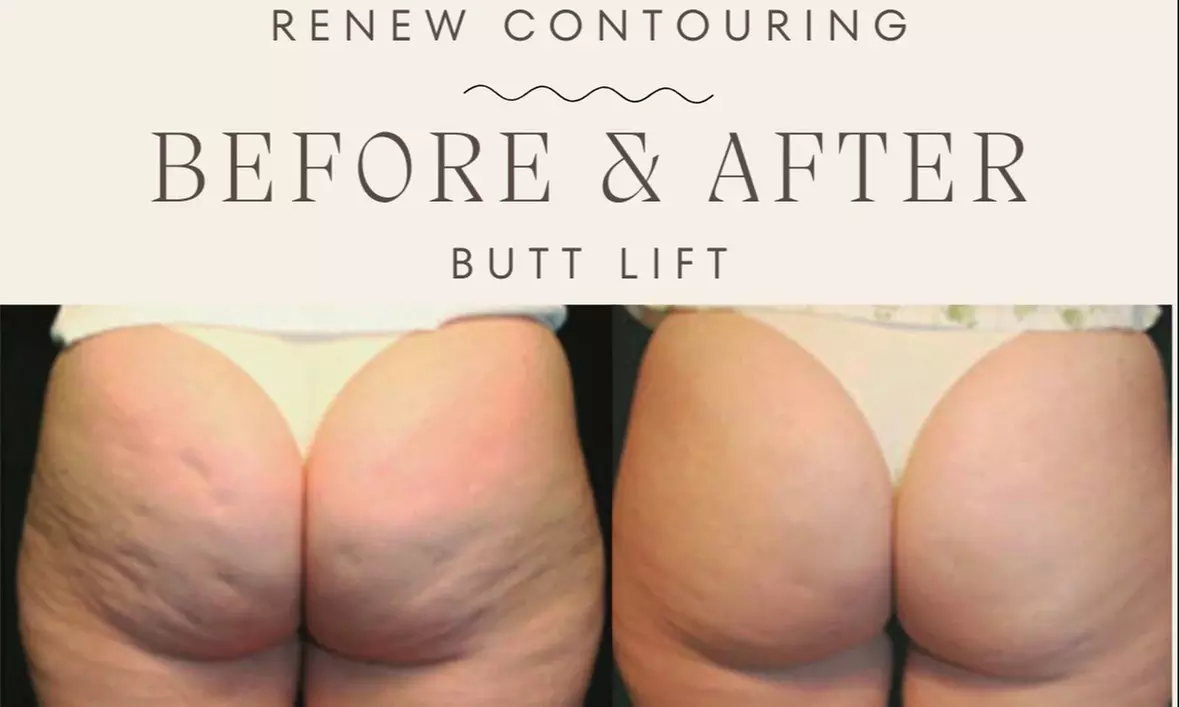 Experience Non-Surgical Butt Lift with Therma-Lift Sessions
