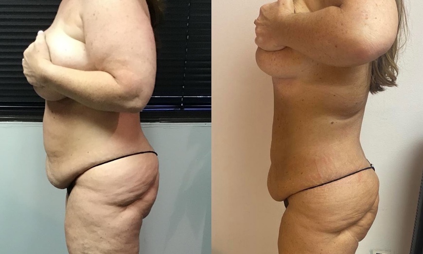 Image 2: Choice of Full Body Zerona Laser Treatment with Whole Body Vibration