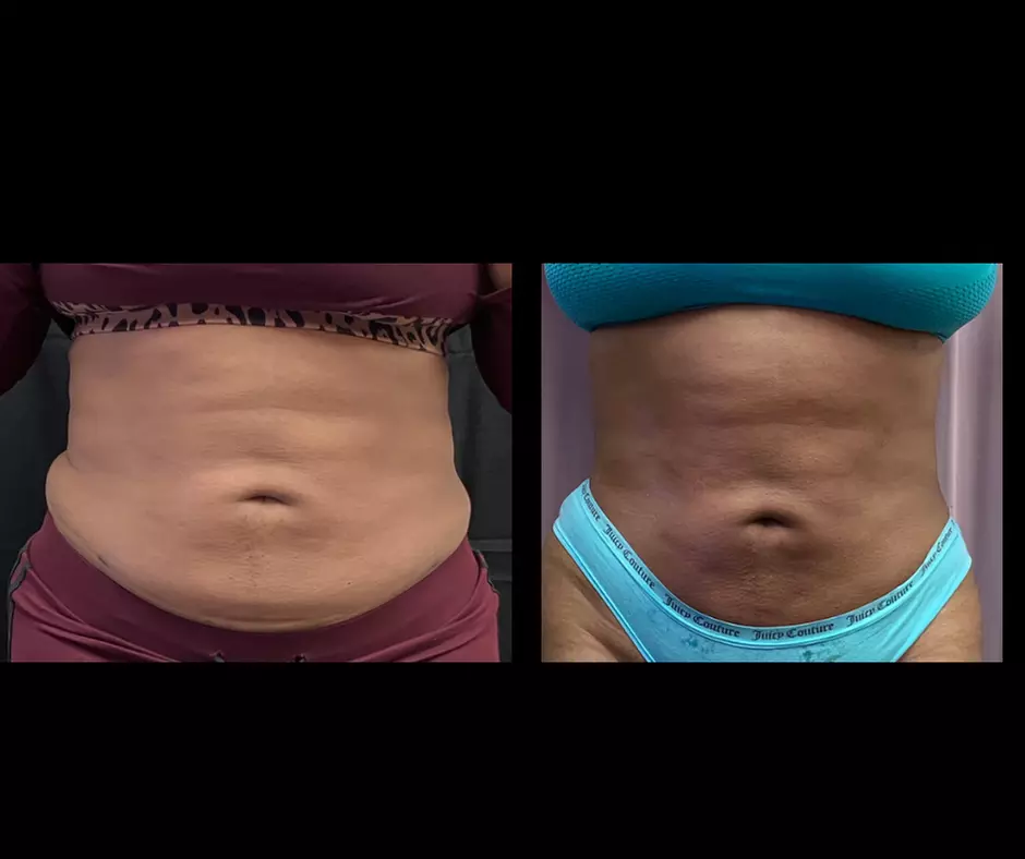 Ultrasonic fat reduction cavitation treatments available