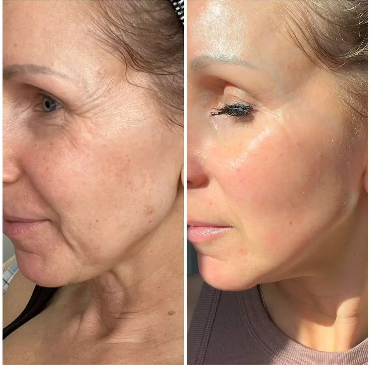 Up to 70% Off HIFU Skin Tightening and Lifting
